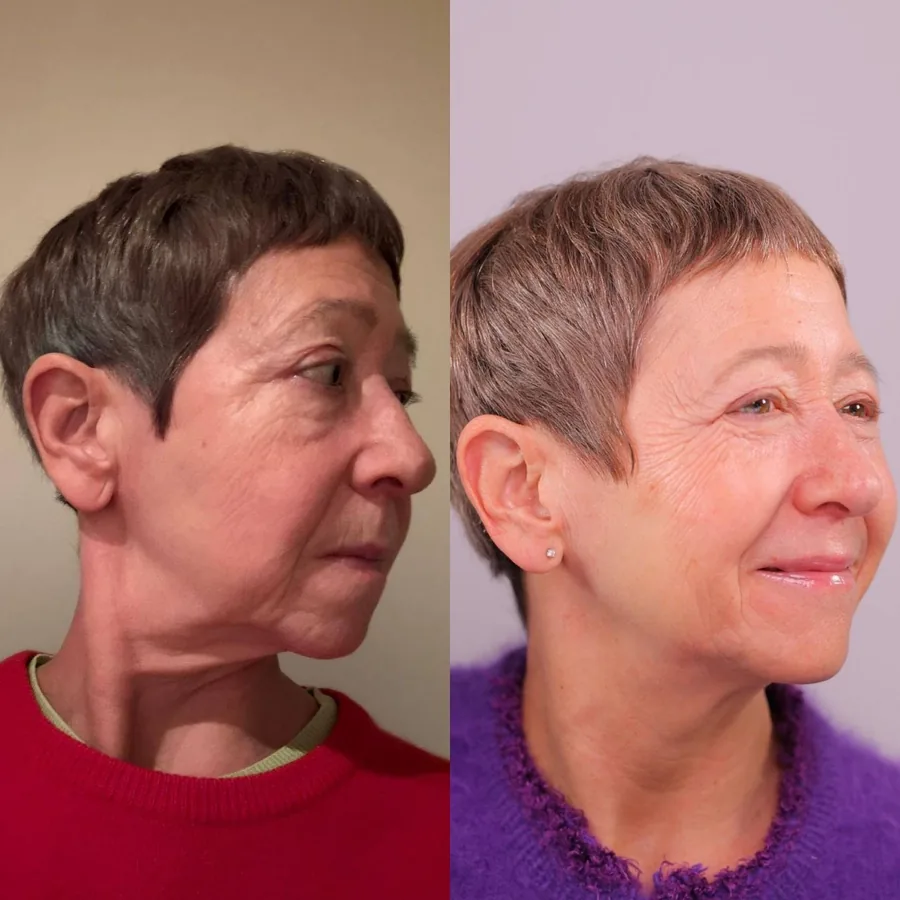 Adry Gone, 65, before and after using the Face Fitness method