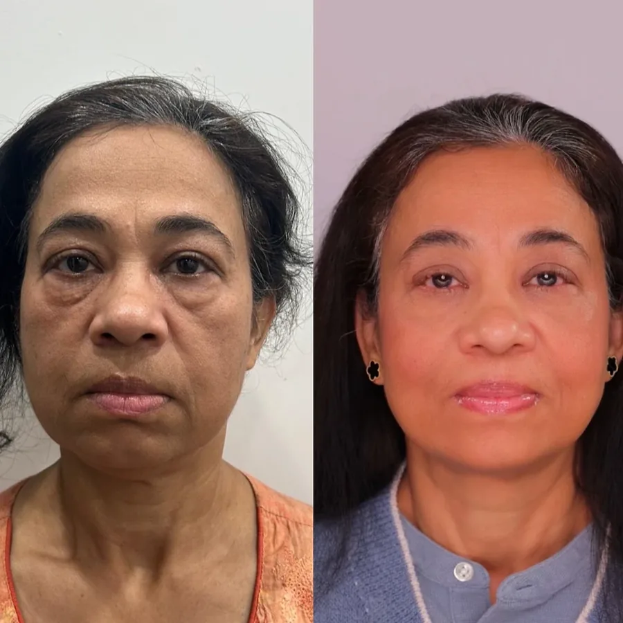 Amelia, before and after using the Face Fitness method