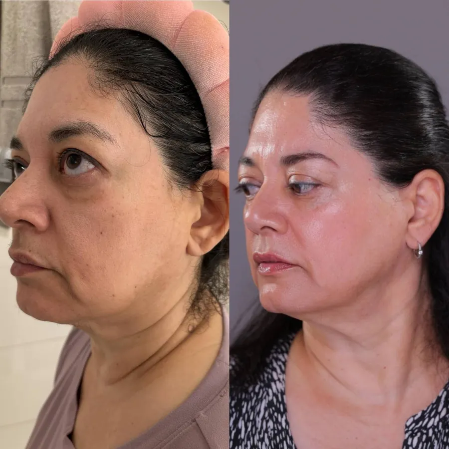 Birgitte Grinvoll, 63, before and after using the Face Fitness method