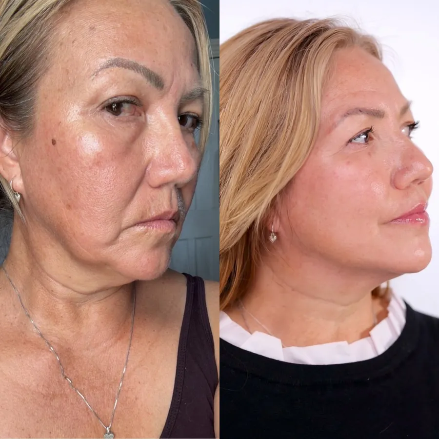 Deborah Reuben, 65, before and after using the Face Fitness method