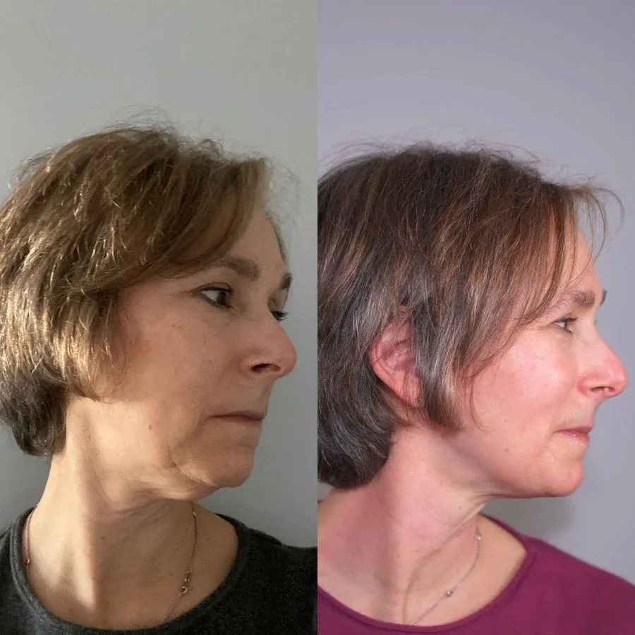 Karen, before and after using the Face Fitness method