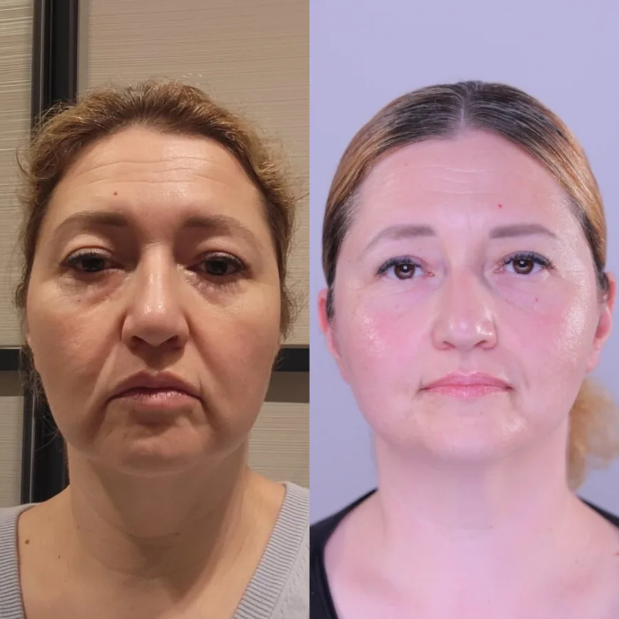 Emma, before and after using the Face Fitness method