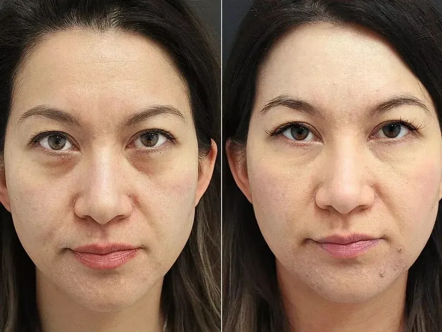 Avery MacDonald, before and after using the Face Fitness method