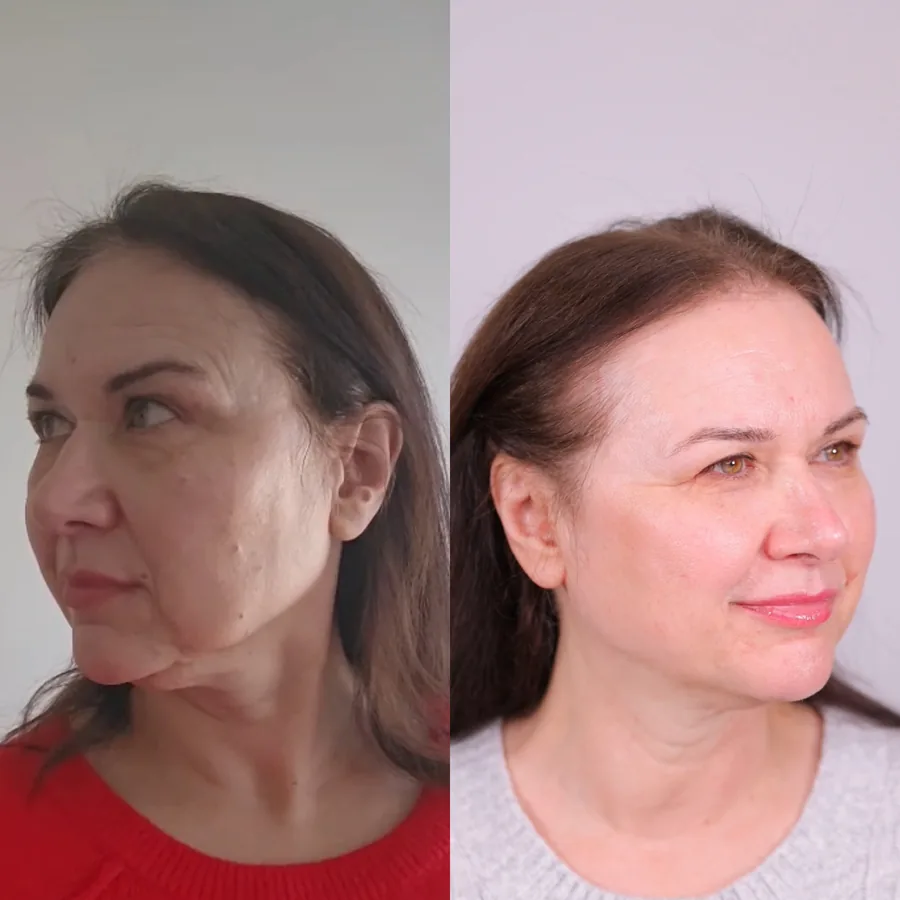Julie Joan, 59, before and after using the Face Fitness method