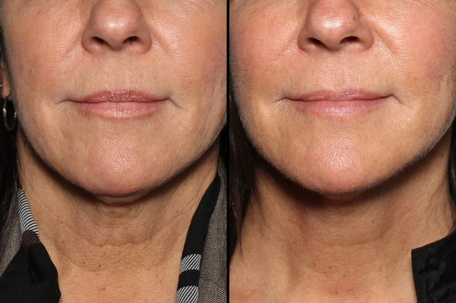 Brooke Lavoie, before and after using the Face Fitness method