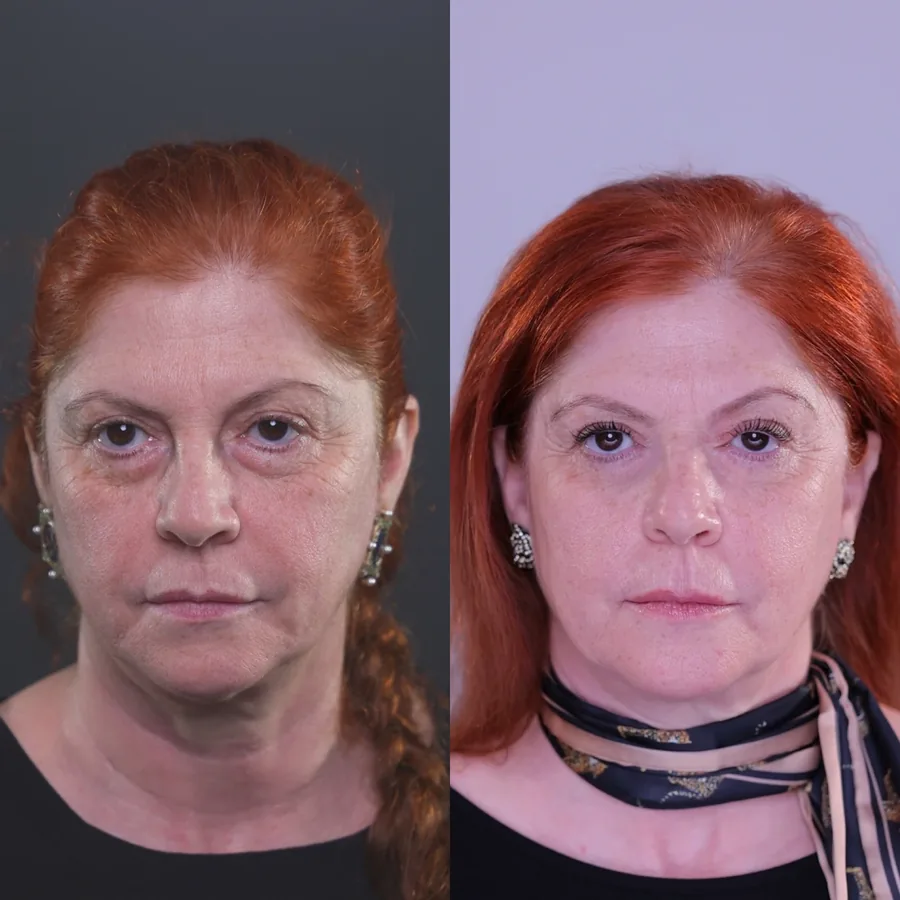 Olivia, before and after using the Face Fitness method