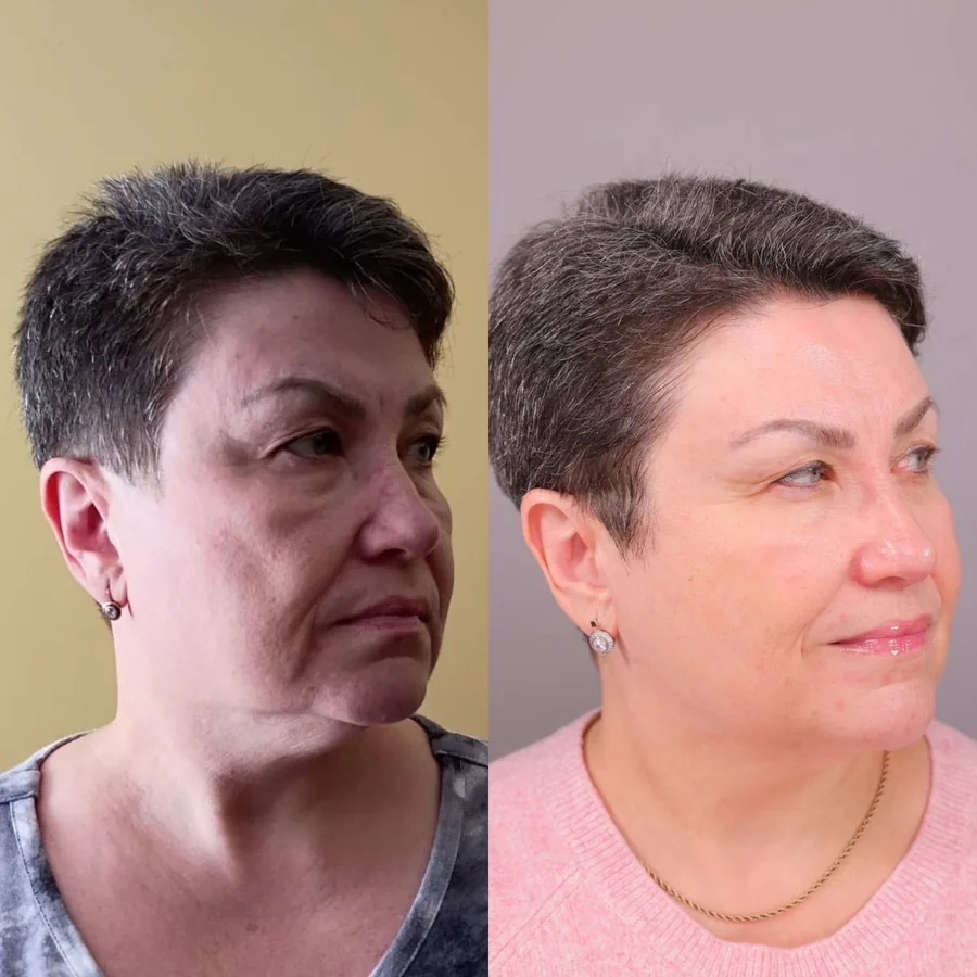 Rhonda, 58, before and after using the Face Fitness method